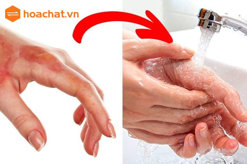 sơ cứu bỏng axit